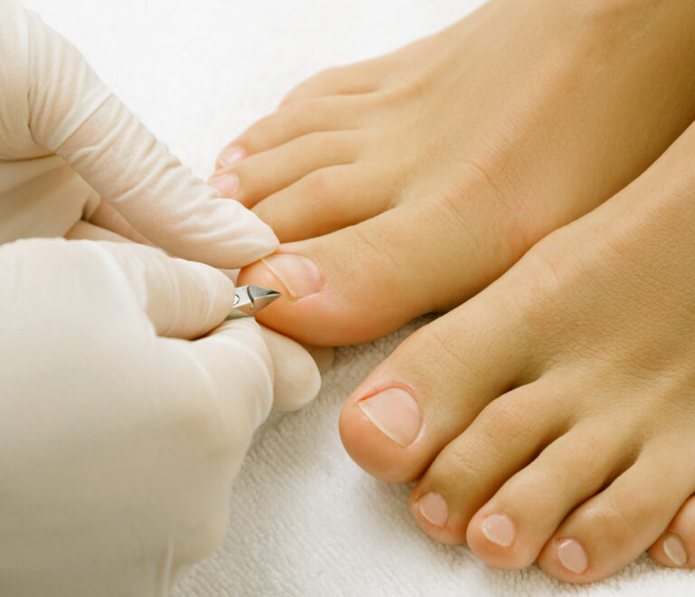 Profesionalni tretman uraslih i deformiranih noktiju