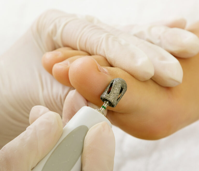 Protetika nokta s antifungalnim gelom